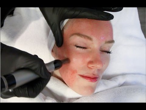 ACNE SCARS DERMAPEN TREATMENT MY VAMPYRE MOMENT EP 