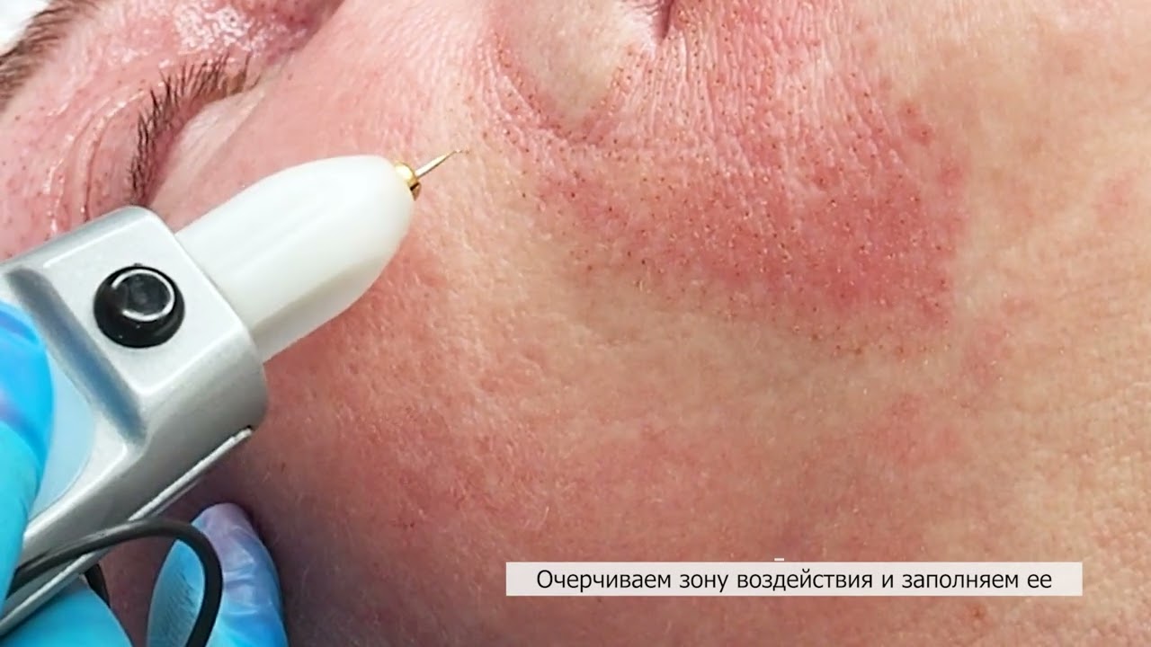 Работа с носогубными складками плазменным аппаратом Ablase