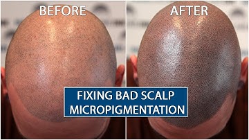 Scalp Micropigentation Gone Wrong FIXED by Hairline Ink