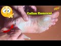 Callus Removal From Feet - 足からのカルス除去＃58