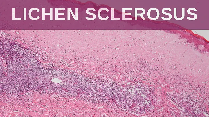 Lichen Sclerosus - Pathology mini tutorial