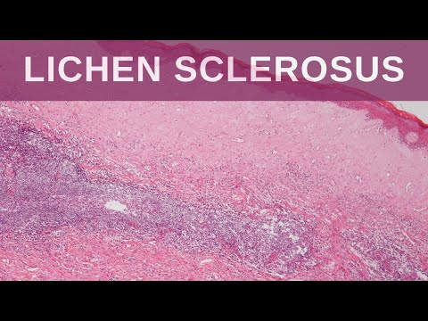 Video: Lichen Sclerosus: Symtom, Orsaker Och Behandling