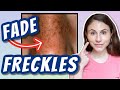 HOW TO FADE FRECKLES| Dr Dray