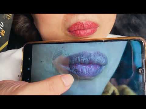 Video Trả Kết Quả Ca Môi Thâm Bẩm Sinh Sau 2 Tháng Làm Tại... - youtube