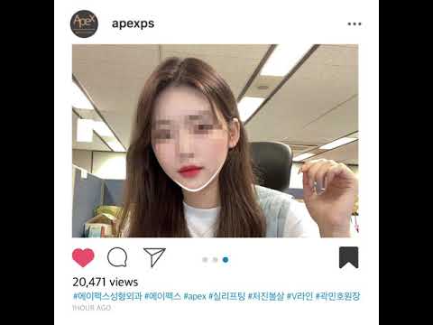 [Thẩm mỹ viện Apex] Khuôn mặt V-line săn chắc và thon gọn✌️Thẩm mỹ viện Apex