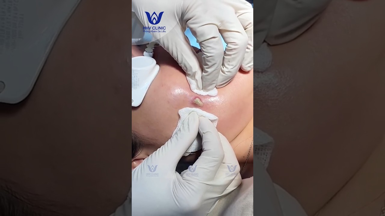 Nặn mụn nhọt mủ ở Má.