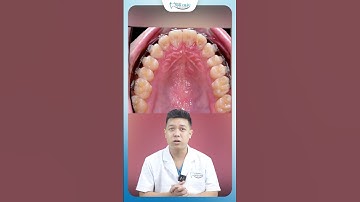Răng Mọc Thụt Vào Trong Lợi Thì Xử Lý Như Nào | Nha Khoa Minh Châu