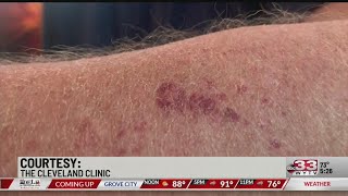 Psoriasis affects more than just the skin