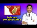 পিত্তথলির পাথরের উপসর্গ, জটিলতা ও ‍চিকিৎসা কি?