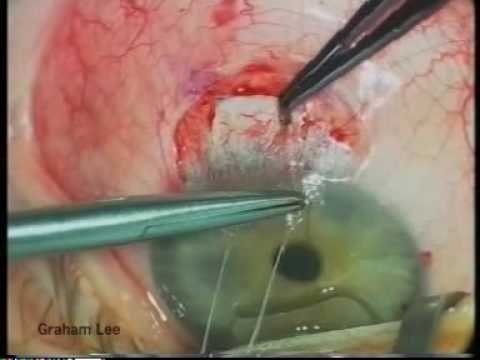 Trabeculectomy with mitomycin-C for complex glaucoma.