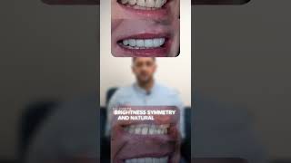 Porcelain Veneers at Re-Ignite Dental