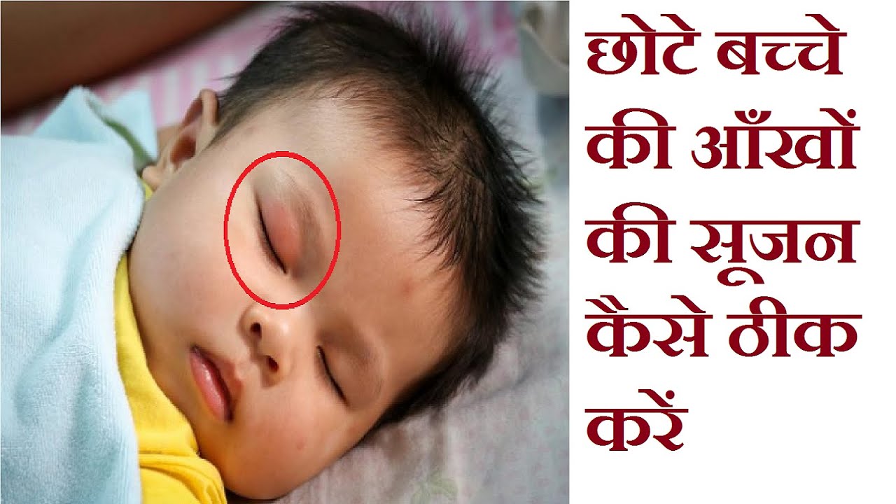 छोटे बच्चे की आँखों की सूजन कैसे ठीक करें उपचार Eye Swelling Mein