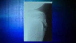 Osgood Shlatters www.footkneepain.com.au Wealth