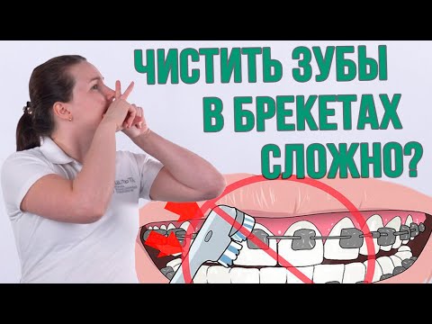 Как правильно чистить зубы в брекетах (Школа здоровых зубов)