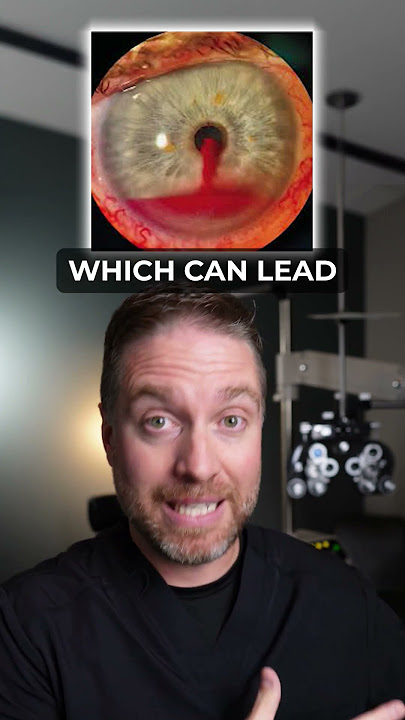 What Caused This Hyphema In The Eye?