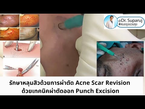 รักษาหลุมสิวด้วยการผ่าตัด Acne Scar Revisionด้วยเทคนิคผ่าตัดออก Punch Excision หมอรุจชวนคุย