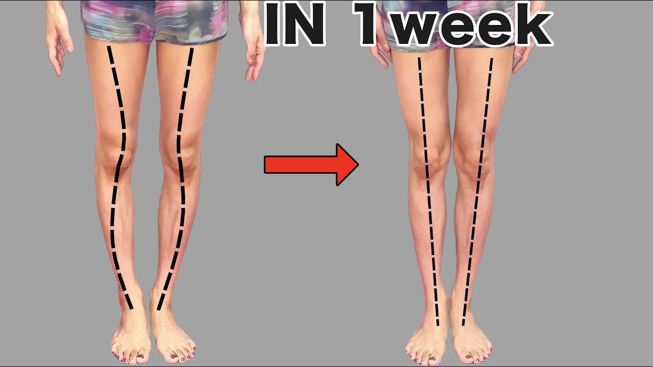 Получите прямые и длинные ноги за 1 неделю! Исправить внутреннее вращение колена (искривленные ноги)