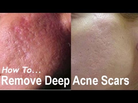 REMOVE DEEP ACNE SCARS? Acne Scarring Removal Treatments! AQA #1