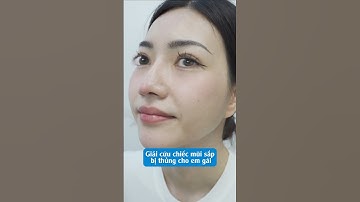 Chiếc Mũi Sắp Bị Thủng? Bác Sĩ Chiêm Quốc Thái Giải Cứu Kịp Thời! #nangmui #bacsichiemquocthai