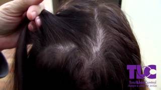 TLC Shows the difference between Lice and dandruff