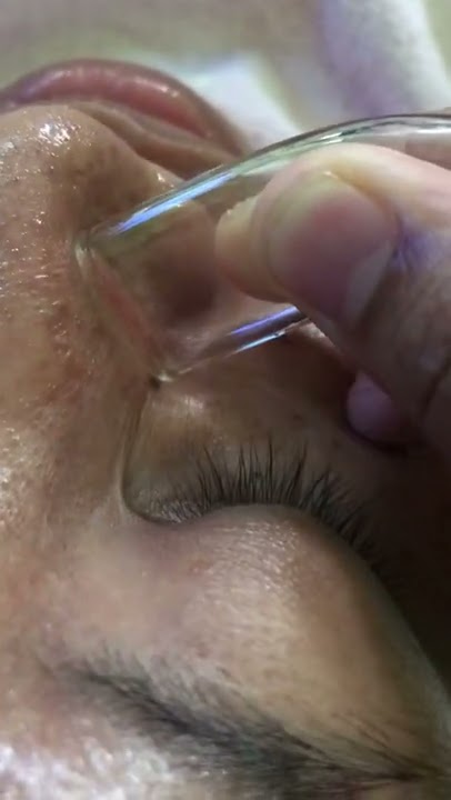 Cara menghilangkan komedo dengan sempurna . Bye bye komedo