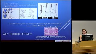 'The Occult Tethered Cord Syndrome'  Petra M  Klinge, MD, PhD