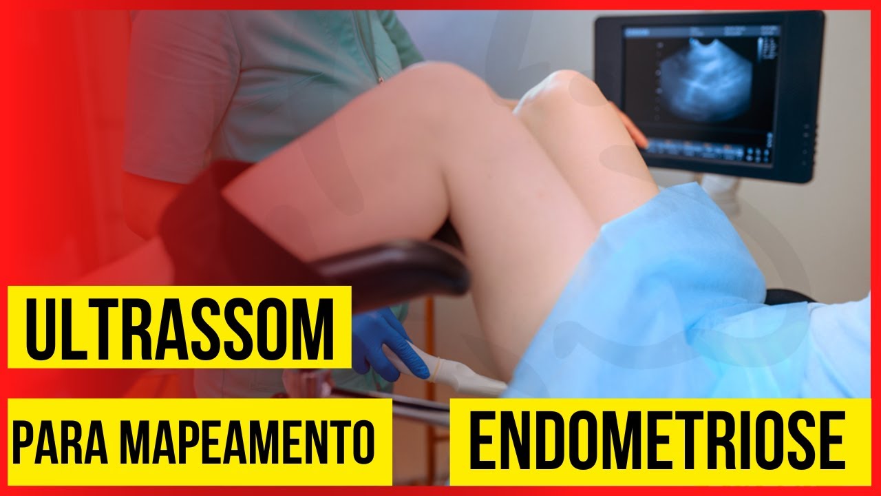 Ultrassom para Mapeamento de ENDOMETRIOSE: Valor? Onde fazer? - YouTube