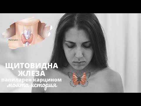 ЩИТОВИДНА ЖЛЕЗА | папиларен карцином | моята история