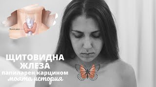 ЩИТОВИДНА ЖЛЕЗА | папиларен карцином | моята история