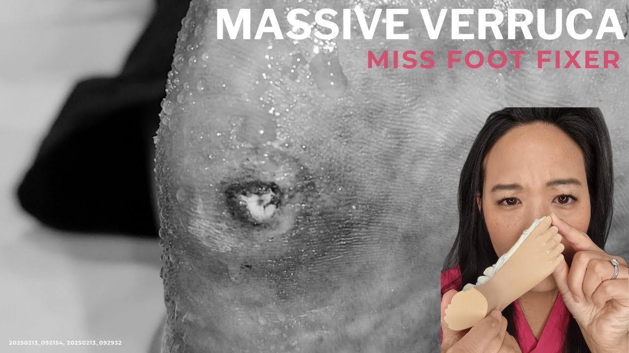 Лазерное удаление мозолей | Послеоперационный уход | Лечение от известного подолога!