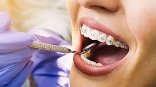 شاهد كيف يتم تركيب تقويم الأسنان (سلك الاسنان )(Dental wire)?