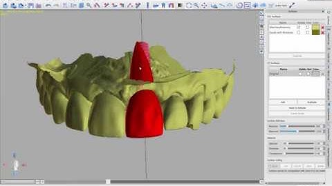 Implant Temp Crown - (1of3) Exporting Data from BlueSkyPlan