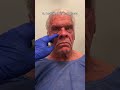 Major male facelift transformation watch until the end 