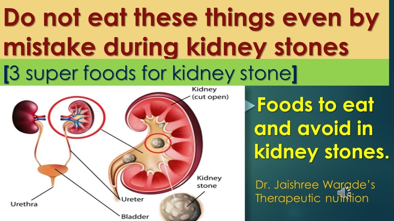 Dietary changes in case kidney stones. Foods to eat and avoid in kidney