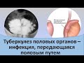 Туберкулез половых органов  - инфекция, передающаяся половым путем