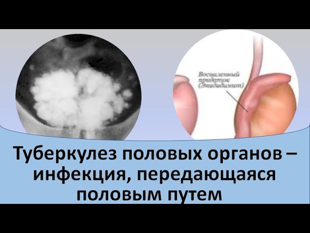 Туберкулез половых органов  - инфекция, передающаяся половым путем