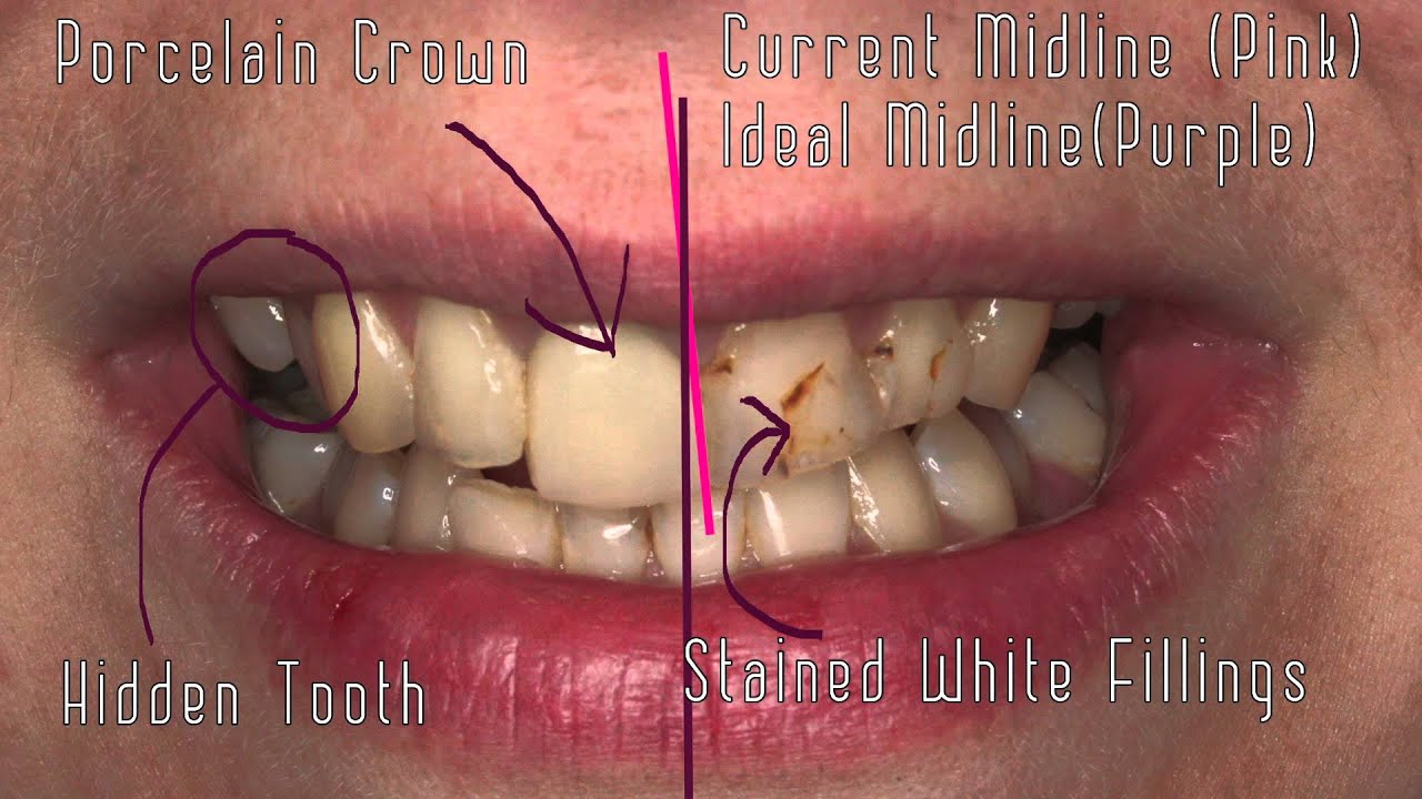 Porcelain Veneers How To Improve The Look of Ugly White Fillings YouTube