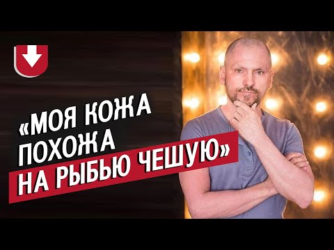 Люди с ихтиозом | Неудобные вопросы