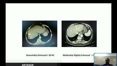 CCMA Webinar Lecture on liver ablation by Dr. Lijesh Kumar