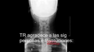 Rx columna cervical A-P