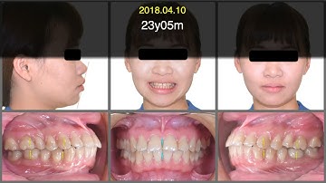 Four premolar extraction treatment with aligners｜【Chris Chang Ortho】CC563
