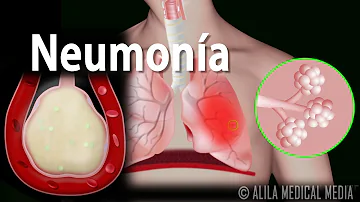 ¿Cómo sabe un médico si tiene una neumonía bacteriana o vírica?