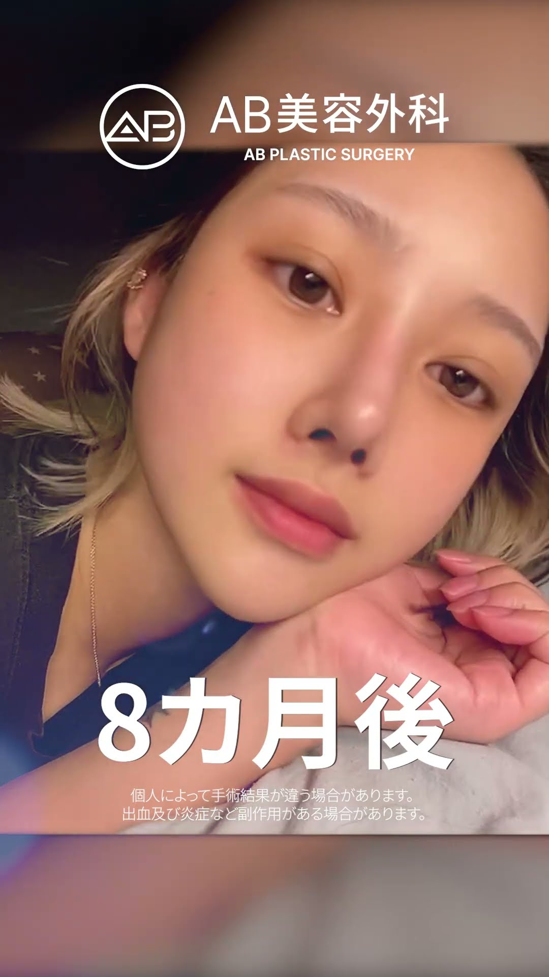 目・鼻・輪郭整形で生まれ変わる美しさ | AB美容外科 #韓国整形 #美容
