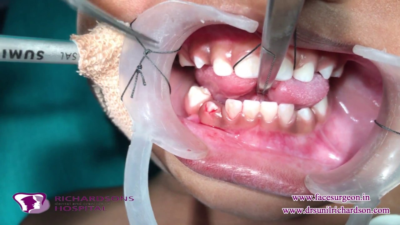 Tongue Tie Release Ankyloglossia YouTube