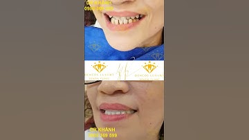 ĐIỀU TRỊ KHỚP CẮN NGƯỢC - BẰNG GIẢI PHÁP BỌC RĂNG SỨ TOÀN HÀM