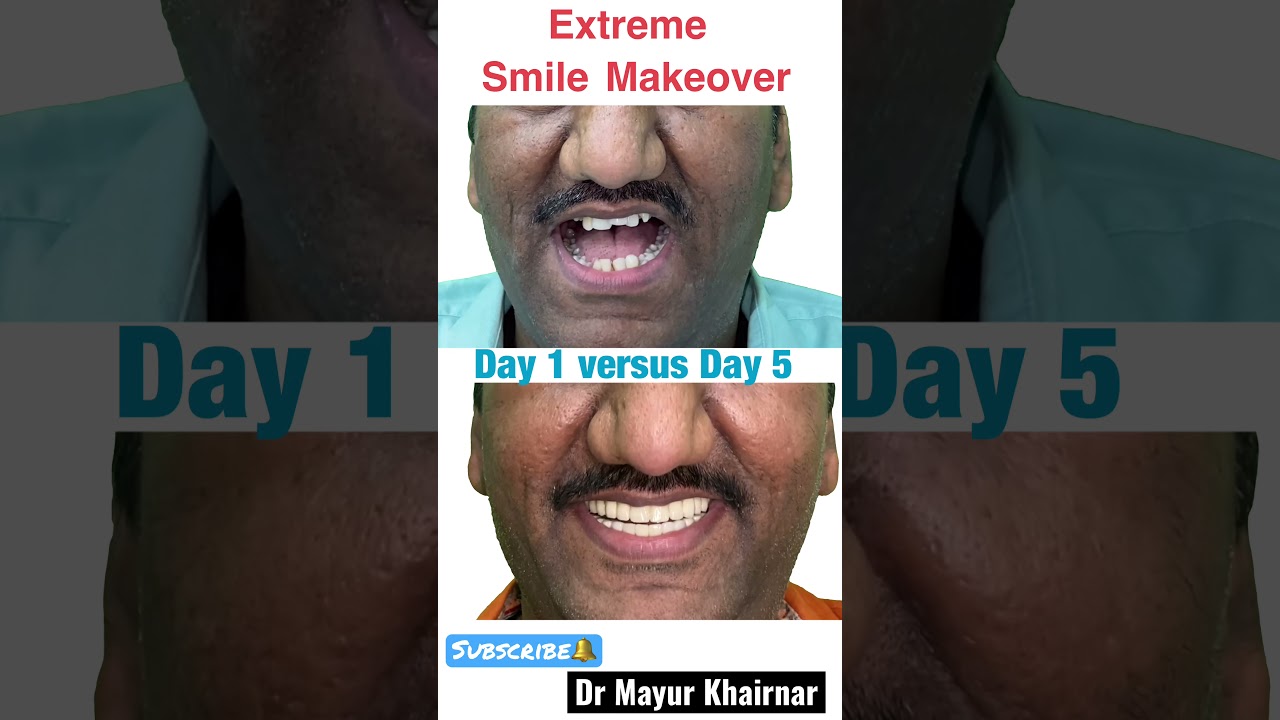 Smile Makeover treatment in Mumbai -Dr Mayur Khairnar | dentist near me | invisalign
