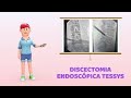 DISCECTOMIA ENDOSCOPICA COLUMNA VERTEBRAL