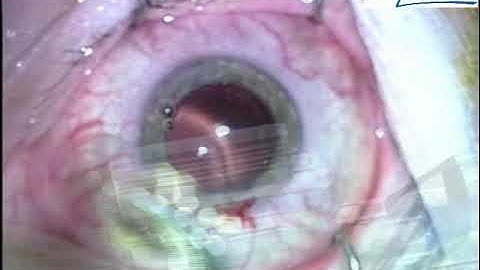 Loading method of PODEYE hydrophobic monofocal IOL