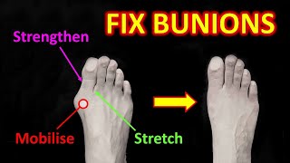 How To Fix Bunions. The 4 Most Effective Exercises. (& 3 Causes)