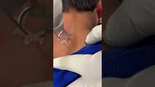 laser tattoo removal | Laser tattoo removal results | Skinaa Clinic #shorts #viral